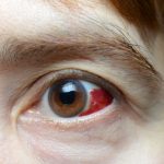 How to Heal Broken Blood Vessel in Eye Fast feature image