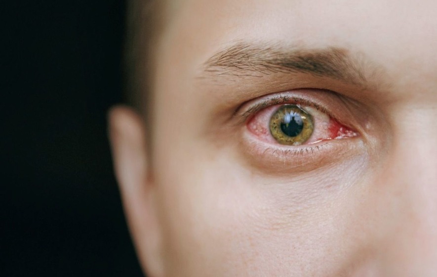 How to Heal Broken Blood Vessel in Eye Fast