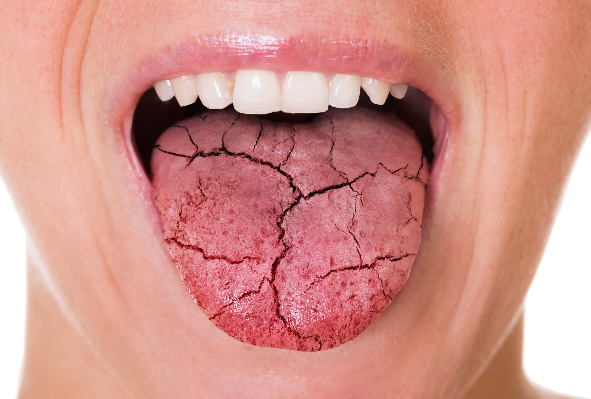 dry mouth-Phentermine Side Effects In Females